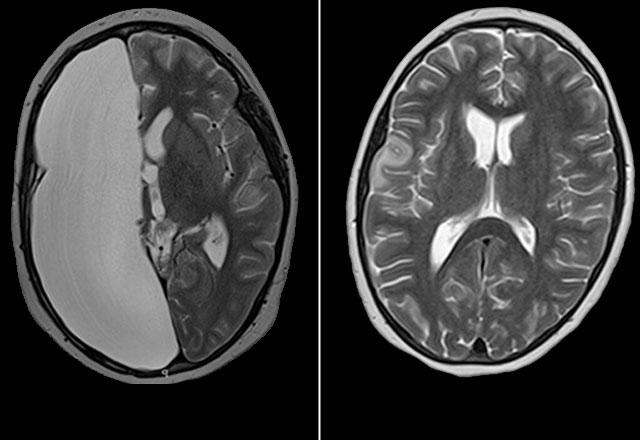 Before and after treatment brain MRI